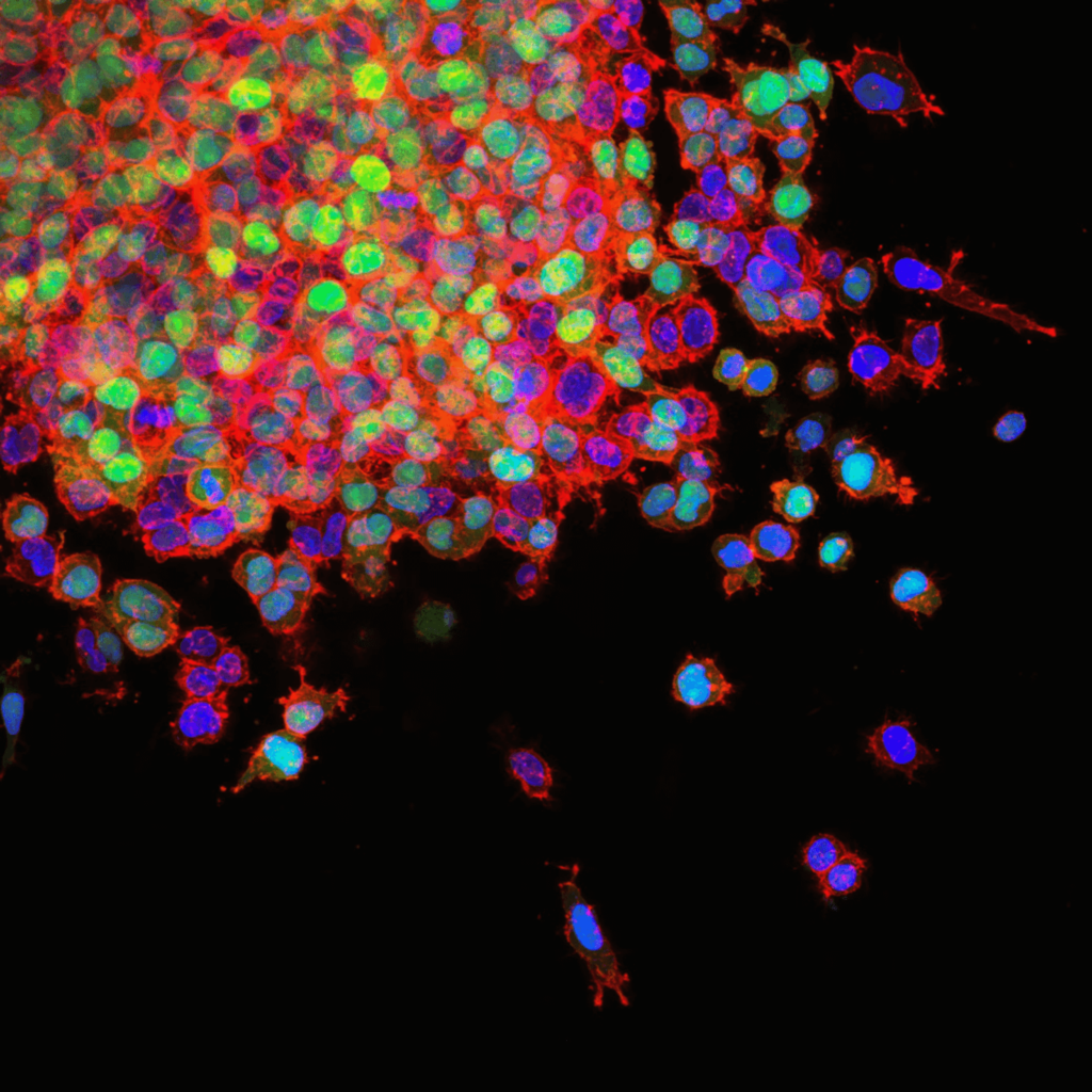 Lung Cancer Metastasis